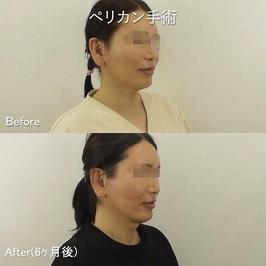 【下アゴのたるみスッキリ！】ペリカン手術(アゴ下筋肉縛り)の50代男性６ヶ月症例回転動画