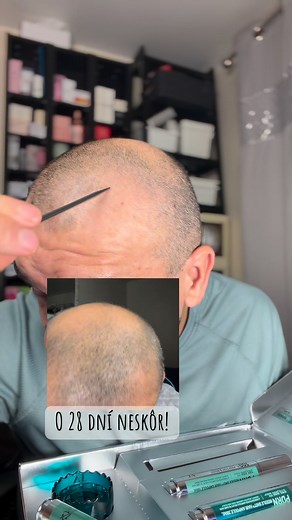 VT 30-DAY Hair Diary. It works! I’ve been using it for the last 4 weeks 🫶🏼 • Get it during the Black Friday Sale from November 21st to December 1st! • Up to 57% Off! • $151.68 - $65 • Available at StyleKorean! • Use my code for a discount!: VLADKO10 #stylekoreanamb_vt #vtcosmetics #hairloss #hairfall #reedleshot StyleKorean | Vladimir Flitar