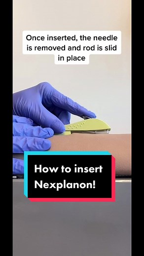 Its a pretty quick procedure! Will post the removal next. #nexplanon #nexplanoninsertion #larc #contraception #birthcontrol #afabhealth #sexualhealth #healthadepopit