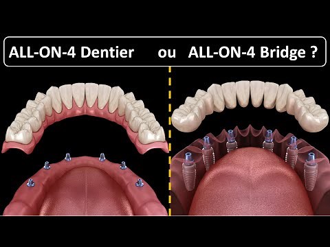 All on 4 - Type de prothèse : Dentier ou Bridge ?