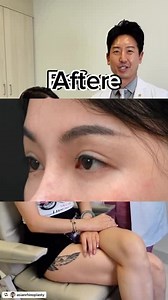 Revision Asian Blepharoplasty