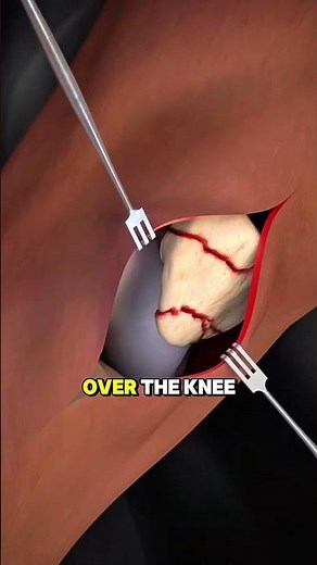 Patella Fracture Repair Surgery (3D Animation:#PatellaFracture #KneeSurgery #OrthopedicSurgery #Medi