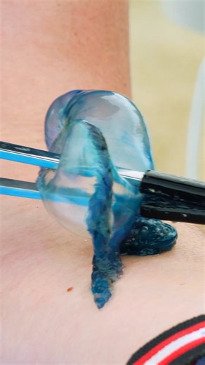 Mark Vins on Instagram: "This sting test was one of my worst ever! But the recovery? Watch to find out! #wildlife #bravewilderness #animals #jellyfish #manowar #underwater #florida"