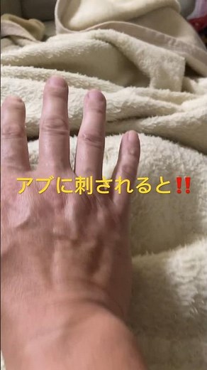 アブに刺されると❗️（噛まれる）こうなります‼️右手と左手の差 蜂虫刺され
