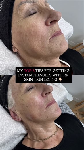 Getting instant skin tightening using RF comes down to precision…. You need to master the science that drives results to consistency deliver for your clients You must study your machine, the temperature, the technique, the conductor and how to get even better results by tweaking your own equipment. I often get asked how we consistently get results for clients that keep getting better and better as time goes on and why others don’t get results at all…. It comes down to these three things: 1️⃣Scie