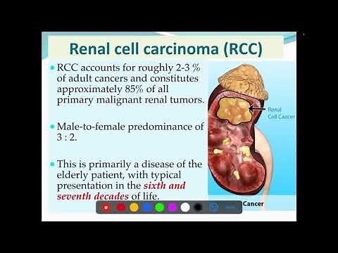 Renal cell carcinoma ( RCC ; Aetiology , Histopathology , spread)