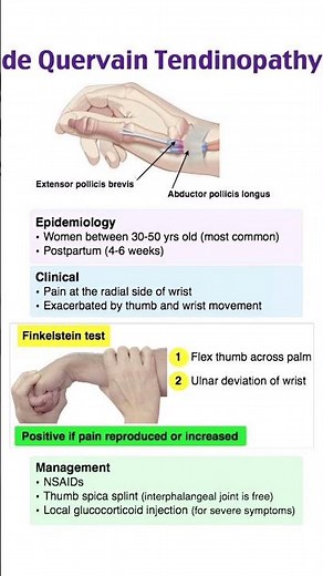 De Quervain Tenosynovitis.#Tenosynovitis #WristPain #ThumbPain #Physiotherapy #HandTherapy