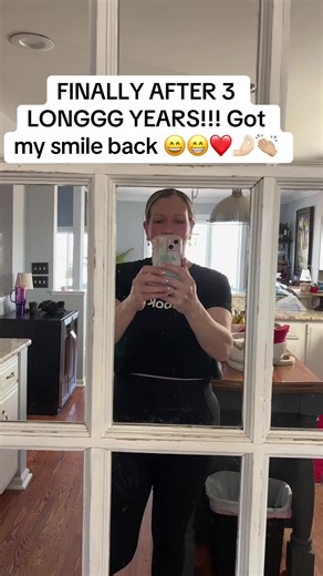 Getting My Permanent Dentures After Three Years