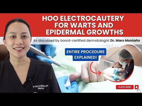 WART REMOVAL WITH ELECTROCAUTERY EXPLAINED
