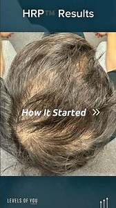 3-months of male hair loss stabilisation with HRP™️ #HRP™️ #hairlosstreatment #DrHopkirk #hair