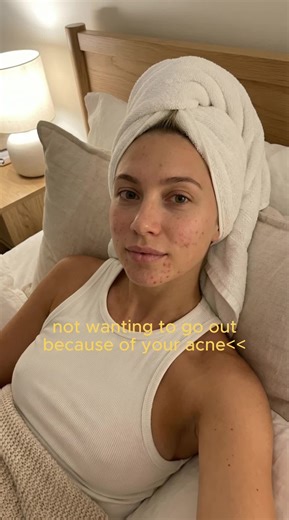 Overcoming Acne Struggles: A Personal Journey