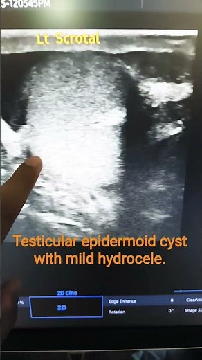 Testicular epidermoid cyst in ultrasound views. #ultrasound #scrotal #Testis #Hydrocele #anatomy