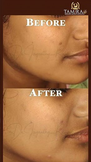 One treatment, completely different skin #beforeandafter #glow #hydrafacial