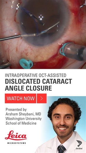 Dislocated Cataract Surgery with the Proveo 8 Ophthalmic Microscope | Leica Microsystems Medical