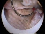 Hysteroscopic Removal of Endometrium • Video • MEDtube.net