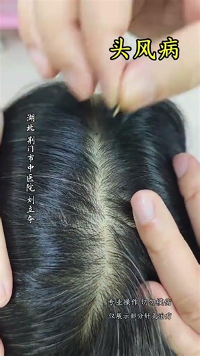 Ancient Secret: Moxibustion with Liu Liduo's TCM Techniques