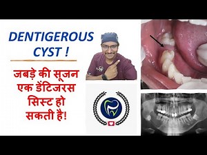 Dr Rudra Mohan | जबड़े की सूजन एक डेंटिजरस सिस्ट हो सकती है! DENTIGEROUS CYST IN SIMPLE WORDS
