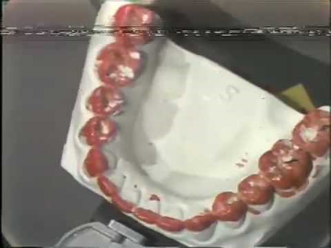 Occlusal Adjustment - Lateral Excursion