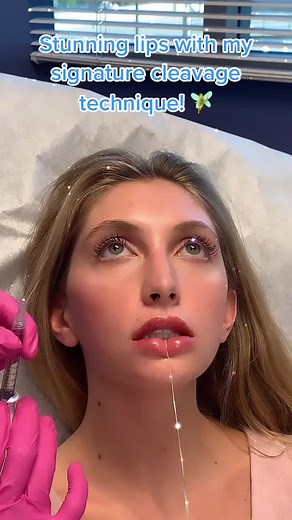 Choosing the Right Lip Injection Technique with Dr. Kay