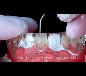 Injection Moulding Technique Tips & Tricks Credit @serhat koken #Dentistry #LearningTips #BitesnBraces | Dr. Syed Naveed Manzoor