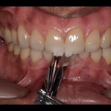 Final Occlusal Adjustments after FMR
