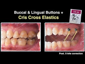 Crowding & Posterior cross bite Aligner｜【Chris Chang Ortho】CC811
