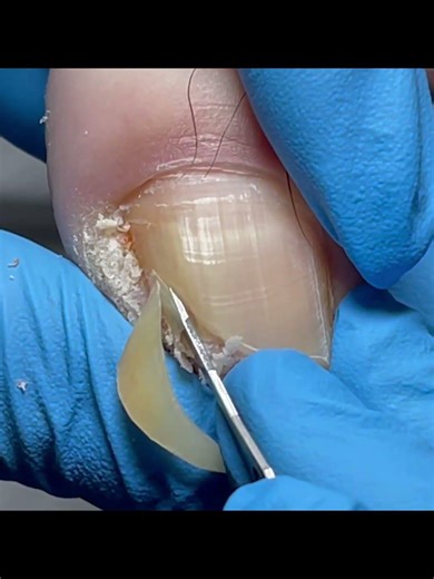 Crooked toenails, trim the damaged side of the nail #nails #pedicure