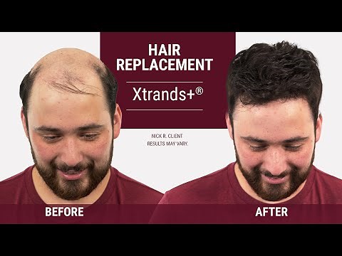 Hair Loss in Your 20s - There is a solution [ Hair replacement transformation ]