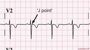 Bite-sized medical tutorial videos created by experts in the field. Become an ECG guru! Learn more: http://bit.ly/2xxtVrK | Acadoodle