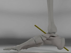 In this three dimensional animation of the lateral view of the weightbearing foot skeleton during closed kinetic chain subtalar joint pronation and supination, the subtalar joint axis is noted to undergo increased declination (i.e. plantarflexion) during pronation and increased inclination (i.e. dorsiflexion) during supination (animation created by Drs. Nicholas Giovinco and Kevin Kirby). | Kevin A. Kirby, DPM