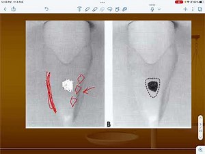 Operative (third-stage) class 3 cavity preparation