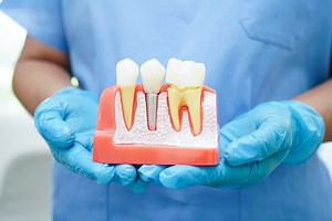 Implant dentaire : pose, prix, remboursement, risques