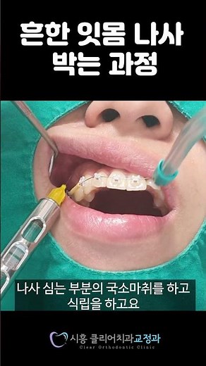교정 중 미니스크류 식립시 주의 할 것