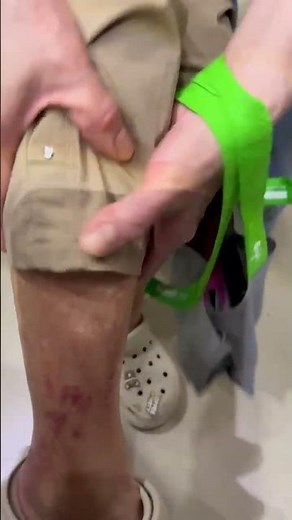 蜂窩性組織炎 好發於老人、糖尿病人的下肢 循環不好 鏈球菌感染 非常注意