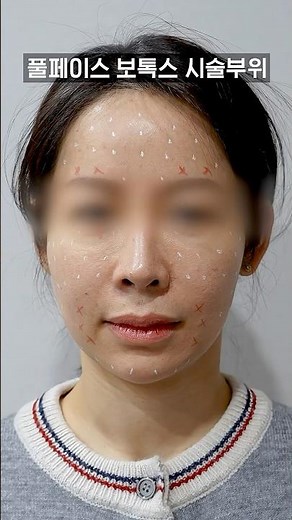 Just a few Botox shots and that's it?? Here is Full-Face Botox that densely fills your entire fac...