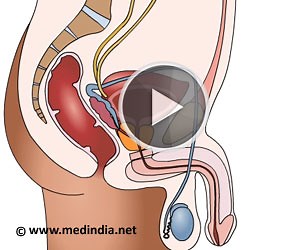 Health Animation - Prostate Enlargement due to Benign Hyperplasia of Prostate or BPH