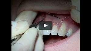 C1-6 Connective Tissue Graft