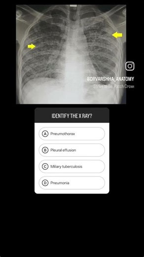 🩻 Respiratory X-ray SeriesCan you identify these chest X-ray findings?