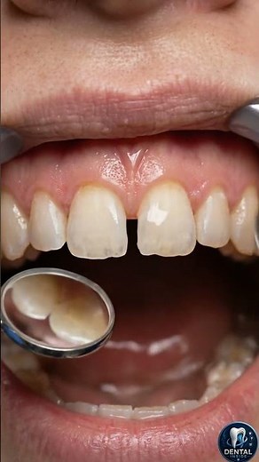 How Front Tooth Gaps Are Closed 🦷 Diastema Repair Explained