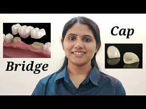 नया दांत कैसे बिठाते हैं? Tooth Cap & Bridge: Types, Procedure