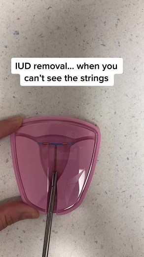 IUD Removal Without Strings: Step-by-Step Guide