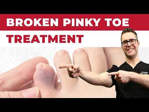 What To Do For A Broken Pinky Toe [How To Tape & Little Toe Treatment]