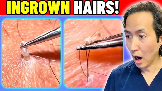 Satisfying Ingrown Hair Extractions: A Plastic Surgeon’s Reaction