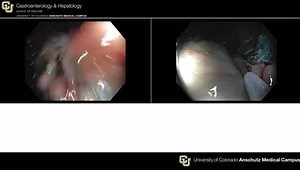 Tackling the Difficult Polyp