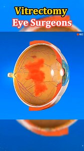 Ever wondered how doctors save vision from the inside of the eye?#EyeSurgery #Ophthalmology #MedicalAnimation #3DMedical #EyeCare #VisionHealth #MedicalEducation #DoctorLife #nonflower #health #viralvideoシ medical 3d animation video | medical 3d animation video