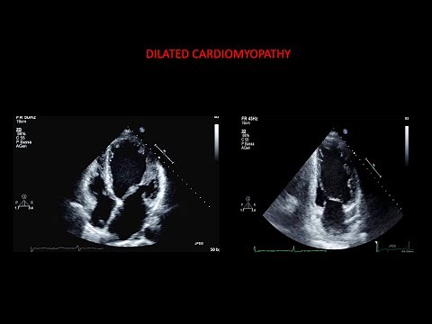 Echocardiography in dilated cardiomyopathy