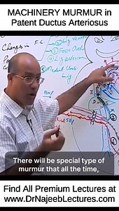 MACHINERY MURMUR In Patent Ductus Arteriosus This Reel is a clip from the "Fetal Circulation " To watch this complete lecture please visit our website. 👇🏻👇🏻👇🏻 www.drnajeeblectures.com If you Sign Up Now you can get lifetime access to our premium lectures for just $45 ONLY. So hurry up and sign up now. The link is below. 👇🏻👇🏻👇🏻👇🏻👇🏻👇🏻👇🏻👇🏻👇🏻 https://members.drnajeeblectures.com/courses/64b6a71fe4b07805c2a499c2-64b6a71fe4b07805c2a499c2?buy=true | Dr. Najeeb