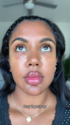 One week after lower bleph with fat repositioning #lowerbleph