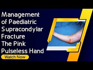 Management of Paediatric Supracondylar Fracture - The Pink Pulseless Hand • Video • MEDtube.net