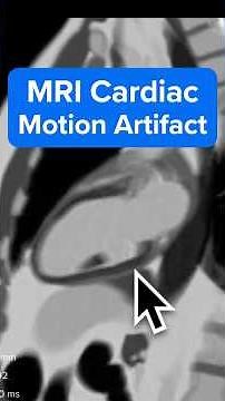 MRI Cardiac Motion Artifact – and How to Prevent It With ECG-Gating